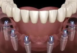 Low Cost Dental Implants Treatment